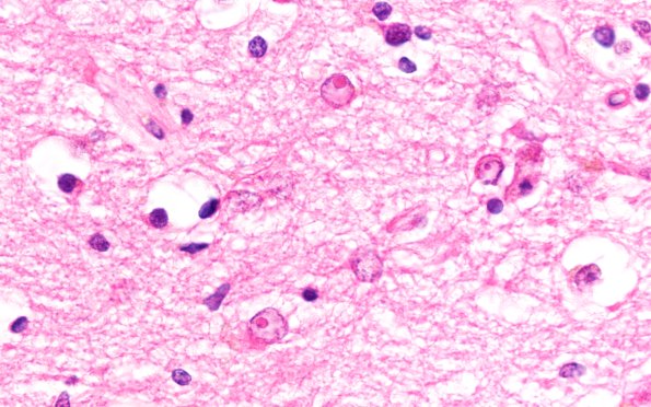 2B8 NIID & Alzheimer Dz (NIID, Case 2) H&E 100X 1