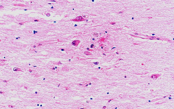 2B9 NIID & Alzheimer Dz (NIID, Case 2) H&E 40X 1