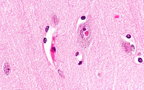 3A4 NIID (AANP DSS 2005-3) cortex cerebral 100X 1