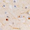 Neuronal Intermediate Filament Inclusion Disease (NIFID)