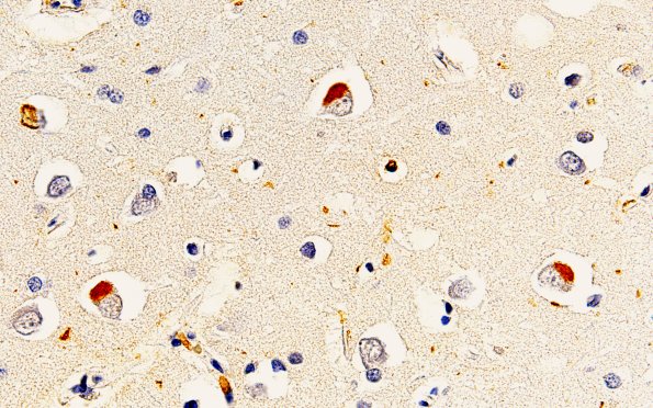 1C2 NIFID (Case 1) Cortex FUS 60X 2