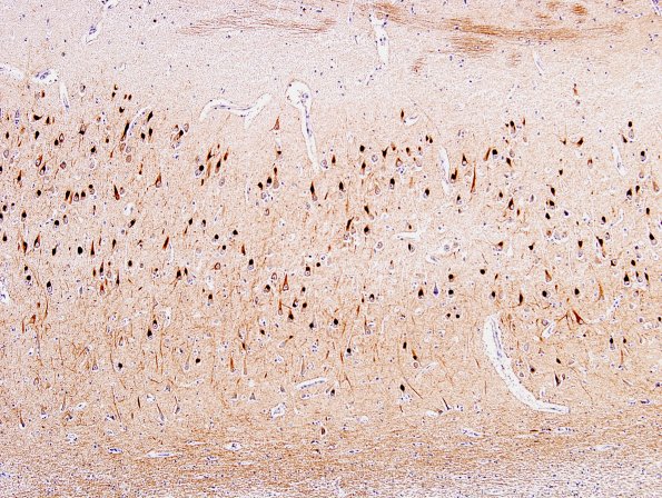 1D3 NIFID (Case 1) Hippo INTX CA1-2 -3