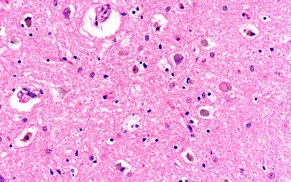 1E1 NIFID (Case 1) L8 Thalamus 40X H&E 3 (2)