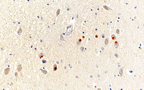 1E10 NIFID (Case 1) L8 Thalamus 40X INTX 2