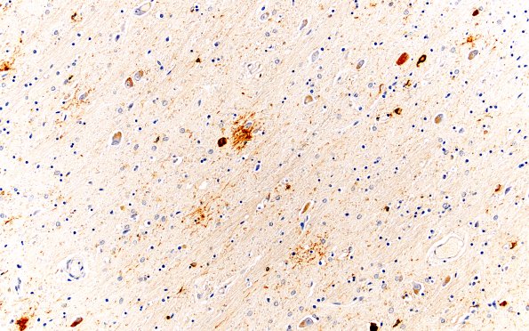 1E11 NIFID (Case 1) L8 Thalamus 20X PHF