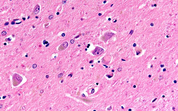 1E2 NIFID (Case 1) L8 Thalamus 60X H&E