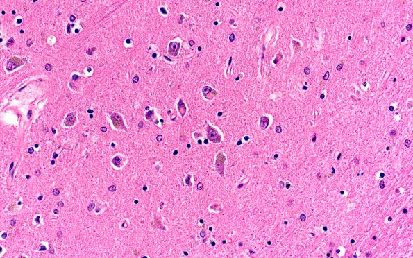 1E3 NIFID (Case 1) L8 Thalamus 40X H&E 3