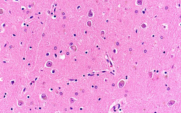 1E4 NIFID (Case 1) L8 Thalamus 40X H&E 4