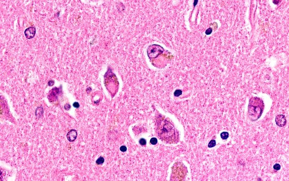 1E5 NIFID (Case 1) L8 Thalamus 100X H&E 3