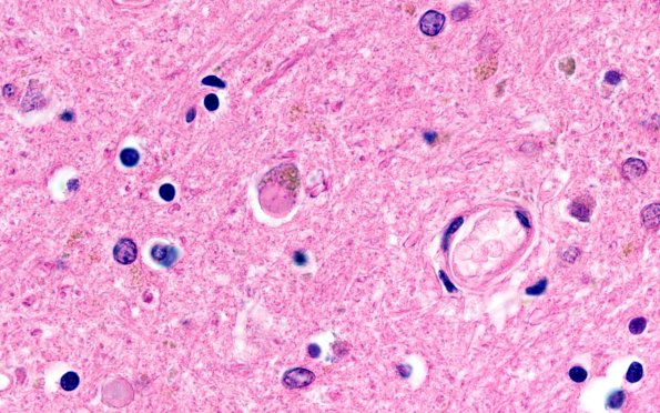 1E6 NIFID (Case 1) L8 Thalamus 100X H&E 4