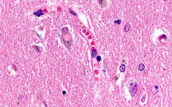 1E7 NIFID (Case 1) L8 Thalamus 100X H&E 6