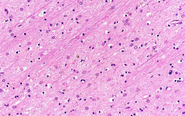 1E8 NIFID (Case 1) L8 Thalamus 40X H&E