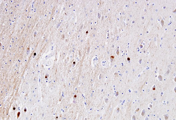 1E9 NIFID (Case 1) Thalamus a-internexin