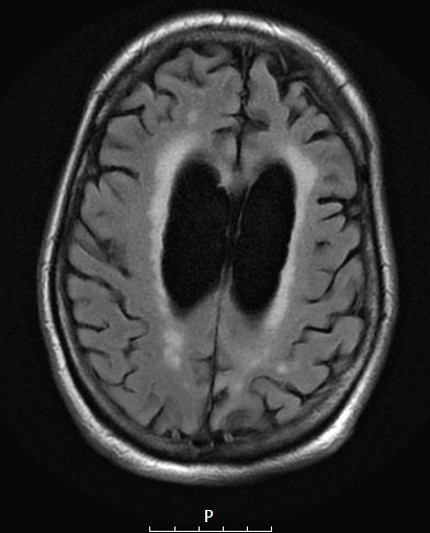 11A1 Pick Dz (Case 11) T2FLAIR - Copy - Copy