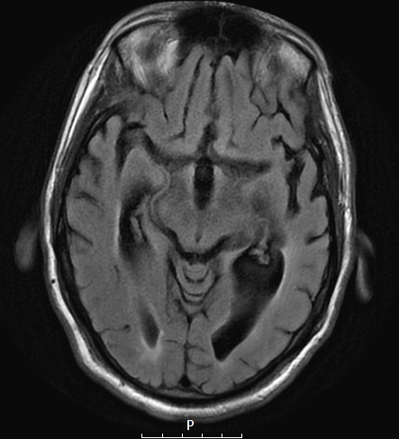 11A2 Pick Dz (Case 11) T2FLAIR 2 - Copy - Copy