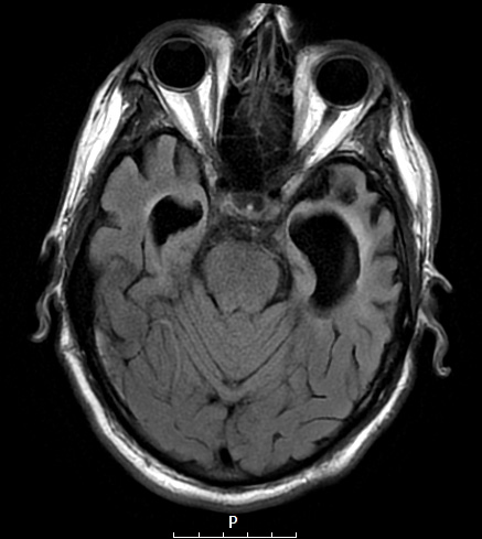 11A3 Pick Dz (Case 11) T2FLAIR 3 - Copy - Copy