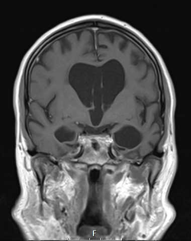 11A4 Pick Dz (Case 11) T1 post Contrast 2 - Copy