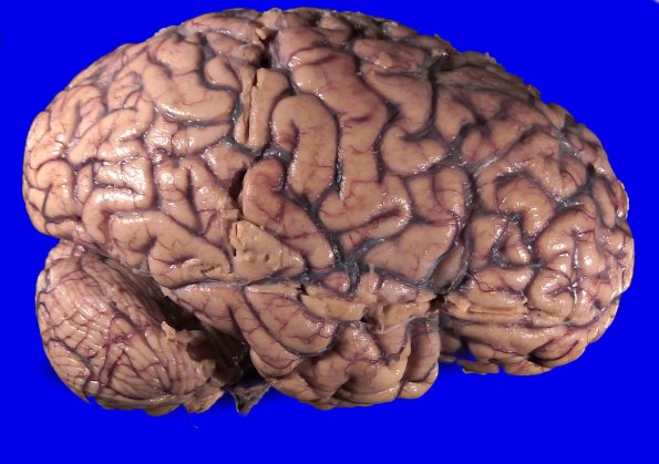 11B3 Pick Dz & ADNC (Case 11)_3