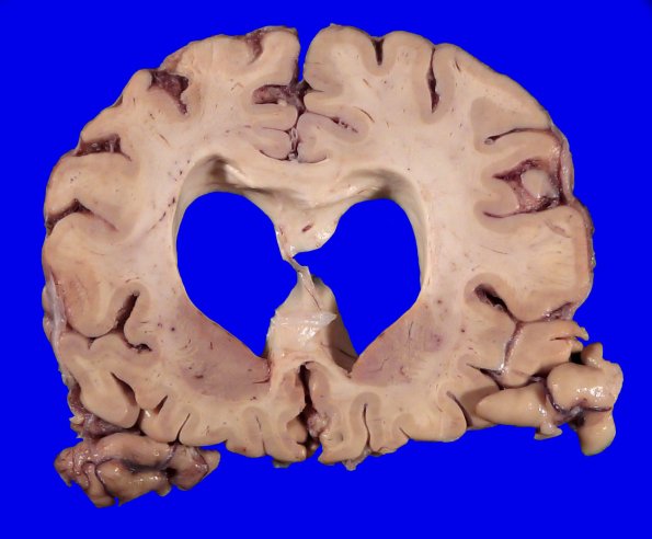 11B5 Pick Dz & ADNC (Case 11)_5