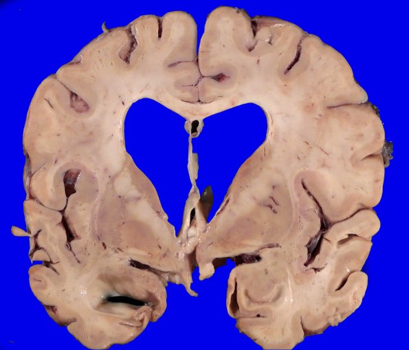 11B6 Pick Dz & ADNC (Case 11)_7