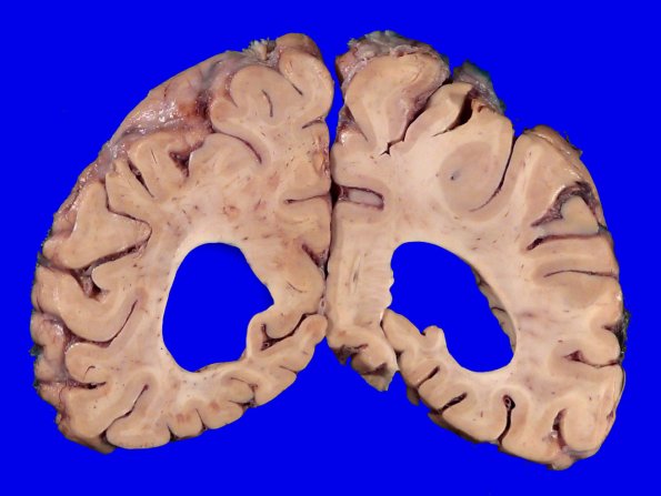 11B8 Pick Dz & ADNC (Case 11)_14