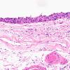 11C2 Pick Dz & ADNC (Case 11) N1 H&E 20X 2