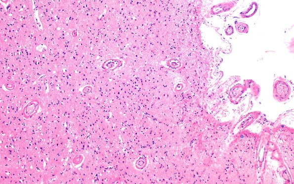 11C3 Pick Dz & ADNC (Case 11) N1 H&E 10X