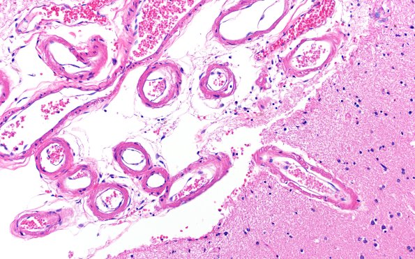 11C4 Pick Dz (Case 11) N14 H&E 20X