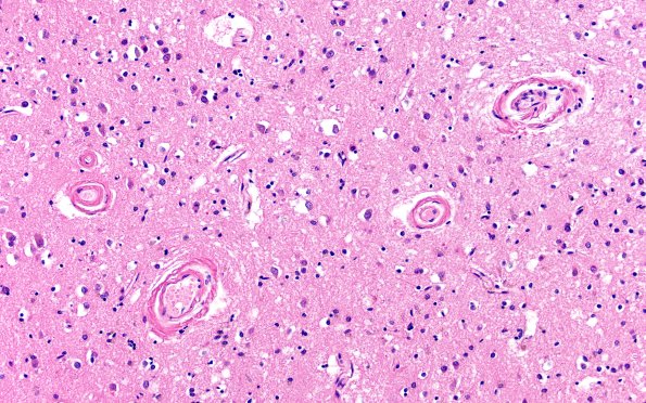 11C5 Pick Dz & ADNC (Case 11) N1 H&E 20X