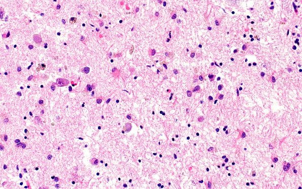 11D10 Pick Dz (Case 11) N3 40X