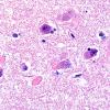 11D3 Pick Dz & ADNC (Case 11) N3 H&E 60X 4 copy copy