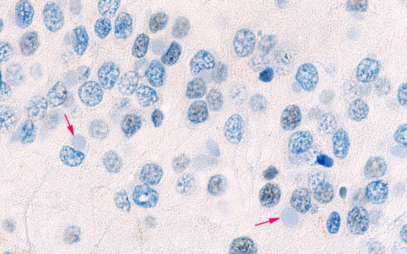 11D9 Pick Dz (Case 11) N3 TDP43 100X 3 copy