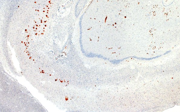 11E1Pick Dz & ADNC (Case 11) BAmyloid 2X