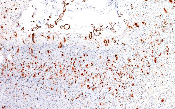 11E2 Pick Dz & ADNC (Case 11) BAmyloid 4X
