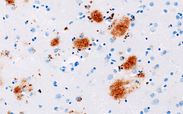 11E3 Pick Dz & ADNC (Case 11) N3 BAmyloid 40X