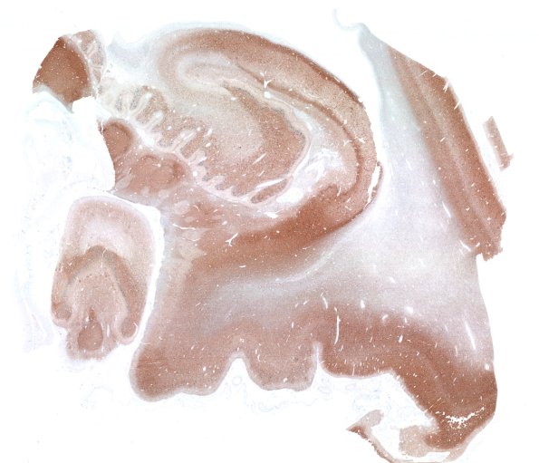 11F1 Pick Dz & ADNC (Case 11) Tau WM