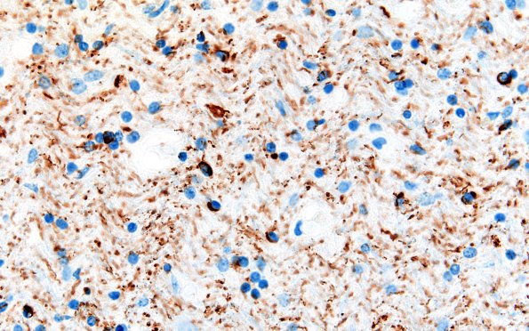 11F11Pick Dz & ADNC (Case 11) N3 WMatter Tau 60X 5