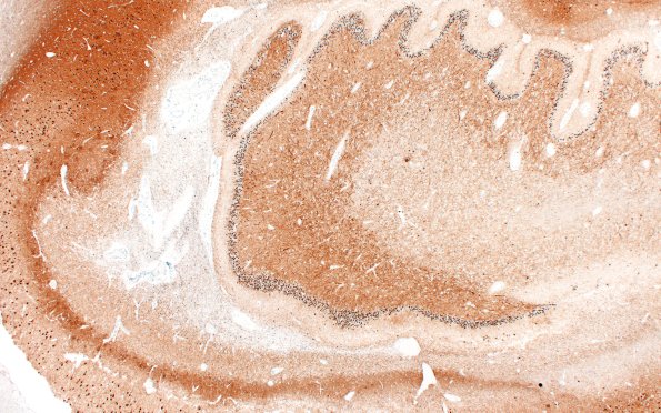 11F2 Pick Dz & ADNC (Case 11) Tau 2X