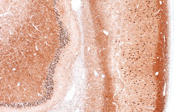 11F3 Pick Dz & ADNC (Case 11) Tau 4X