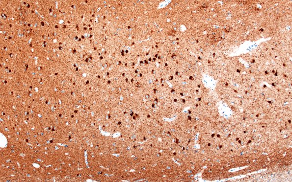 11F4A Pick Dz & ADNC (Case 11) N3 Tau 10X 2