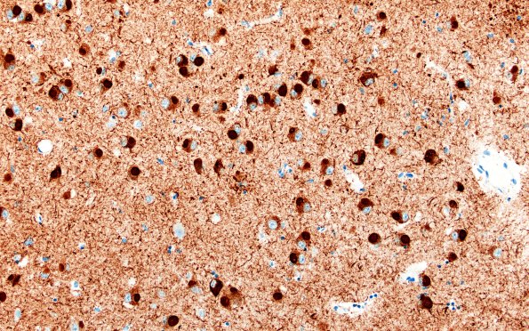 11F4B Pick Dz & ADNC (Case 11) N3 Tau 20X 2