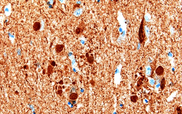 11F5C Pick Dz & ADNC (Case 11) N3 Tau 60X 3