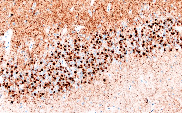 11F7 Pick Dz & ADNC (Case 11) Tau 20X