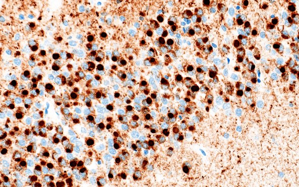 11F8 Pick Dz & ADNC (Case 11) Tau 40X 3