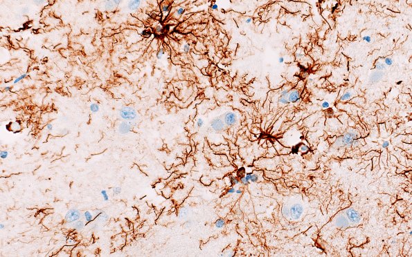 11G2 Pick Dz & ADNC (Case 11) GFAP 40X 2