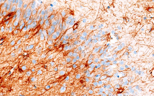 11G3 Pick Dz & ADNC (Case 11) GFAP 40X 1