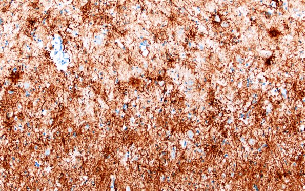 11G4 Pick Dz (Case 11) N3 GFAP area 20X