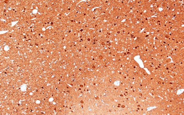 11I1 Pick Dz & ADNC (Case 11) N12 Tau 10X 4