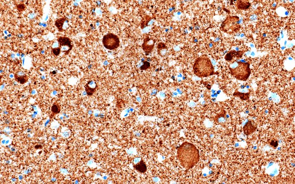 11I3 Pick Dz & ADNC (Case 11) N12 Tau 40X 3