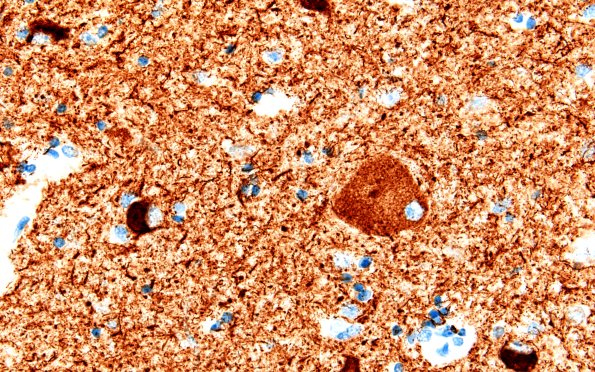 11I4 Pick Dz & ADNC (Case 11) N12 Tau 60X 3